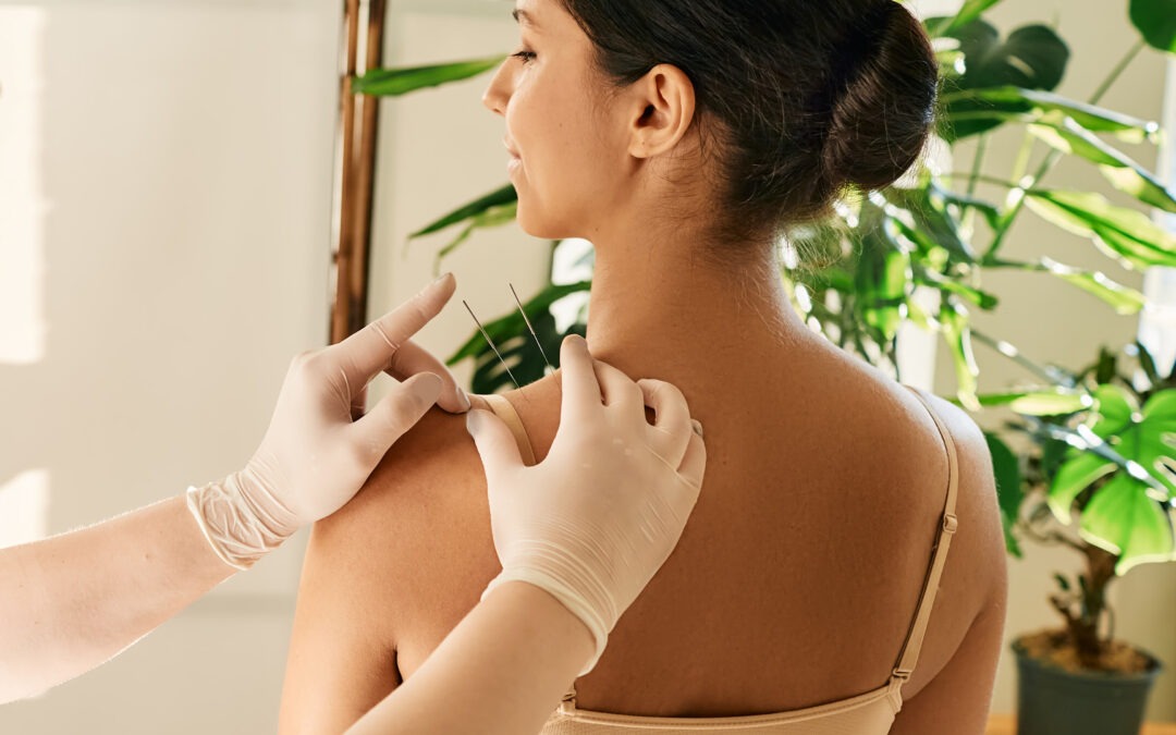 Acupuncture: A Pathway to Well-Being at MyHealth Care Centre