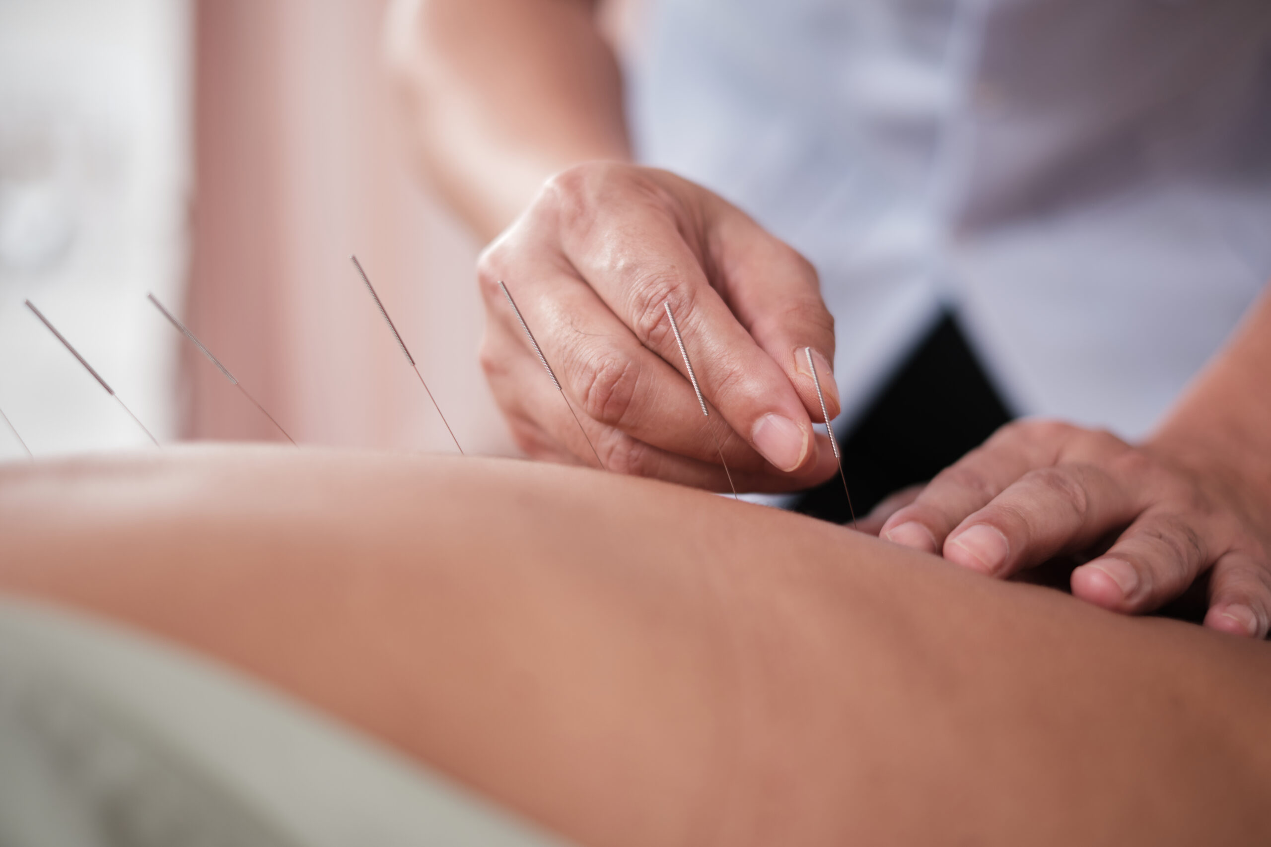 power of acupuncture